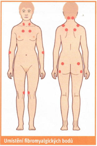 fibromyalgie